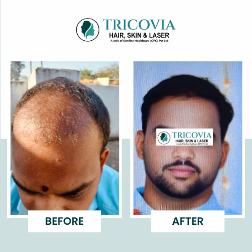 Hair transplant before and after result at Tricovia — case 1