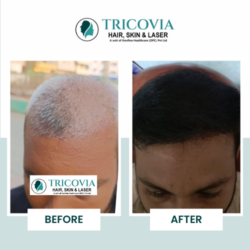 Hair transplant before and after result at Tricovia — case 16