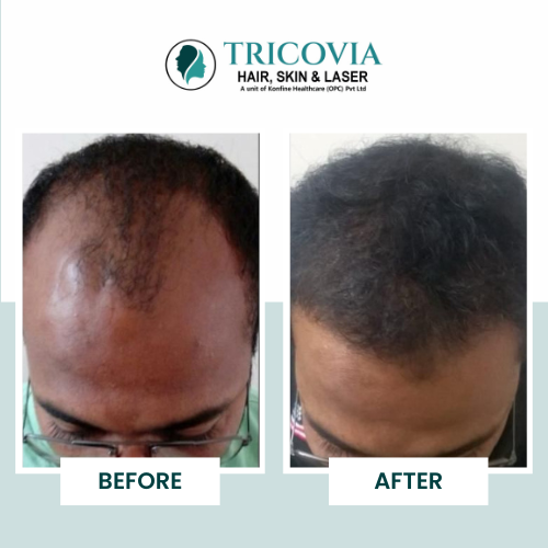 Hair transplant before and after result at Tricovia — case 2