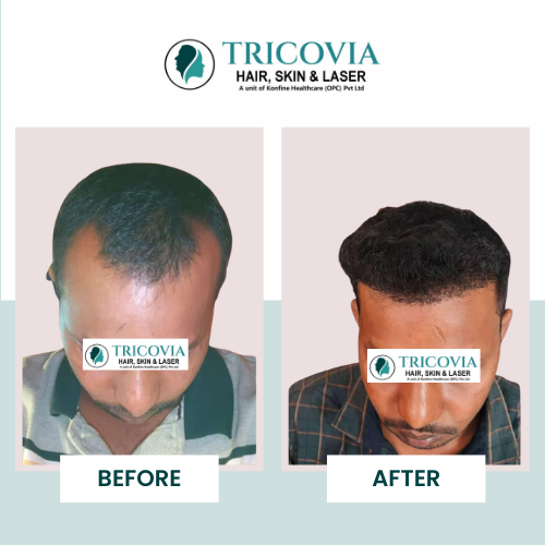 Hair transplant before and after result at Tricovia — case 24