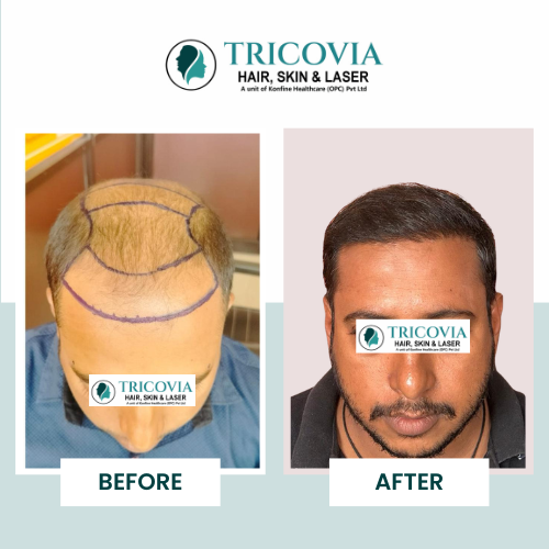 Hair transplant before and after result at Tricovia — case 25