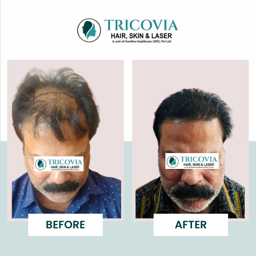 Hair transplant before and after result at Tricovia — case 26
