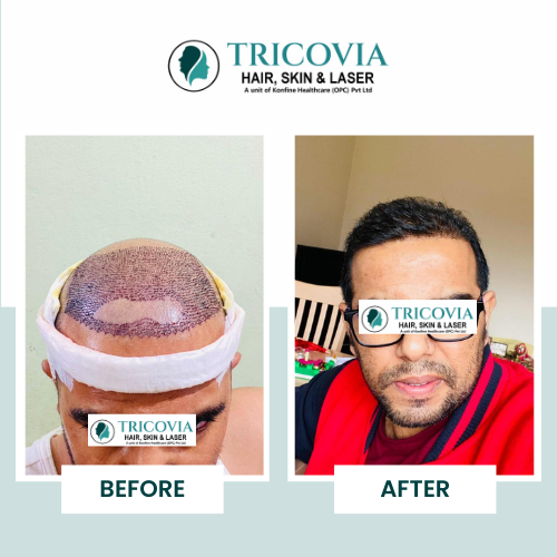 Hair transplant before and after result at Tricovia — case 27