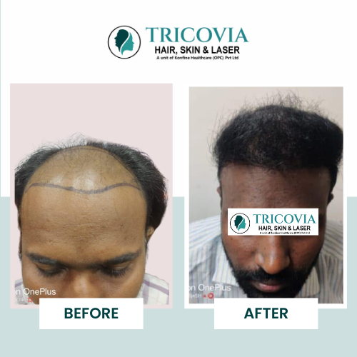 Hair transplant before and after result at Tricovia — case 3