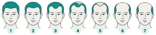 Norwood hair-loss scale, stages 1 to 7 from least to most hair loss